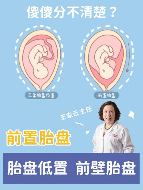 孕4个月胎盘前置怎么办 胎盘前置容易流产吗