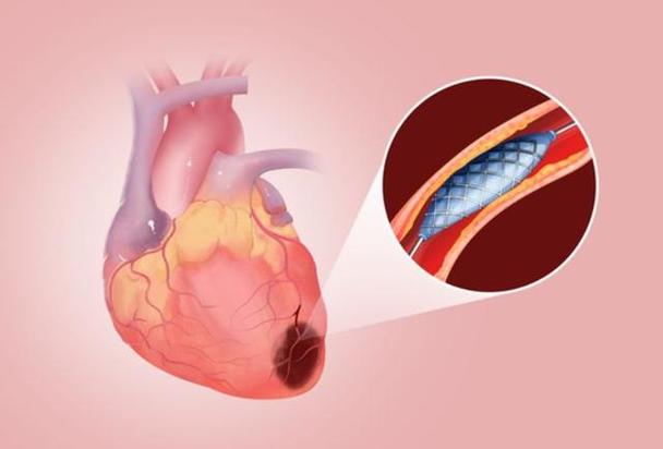 疏通心脏血管的手术要多少钱(1)