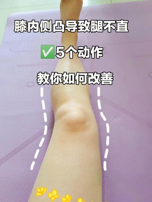 膝盖内扣怎么治疗(1)