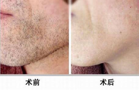 去掉胡子最有效的方法(1)