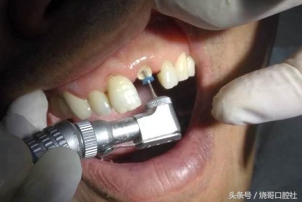 牙齿打桩做冠的过程是什么(1)