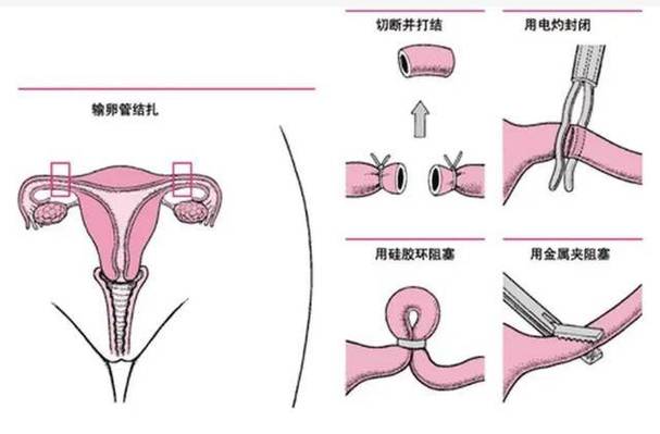 女人做结扎术全过程(1)