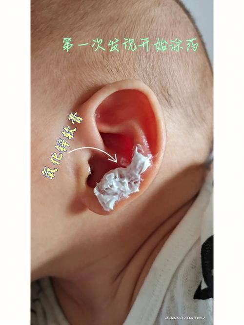 耳朵内湿疹怎么治疗(1)