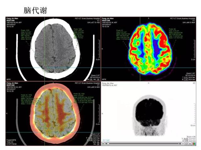 脑血管病检查中 CT MRI DSA PET分别代表什么检查