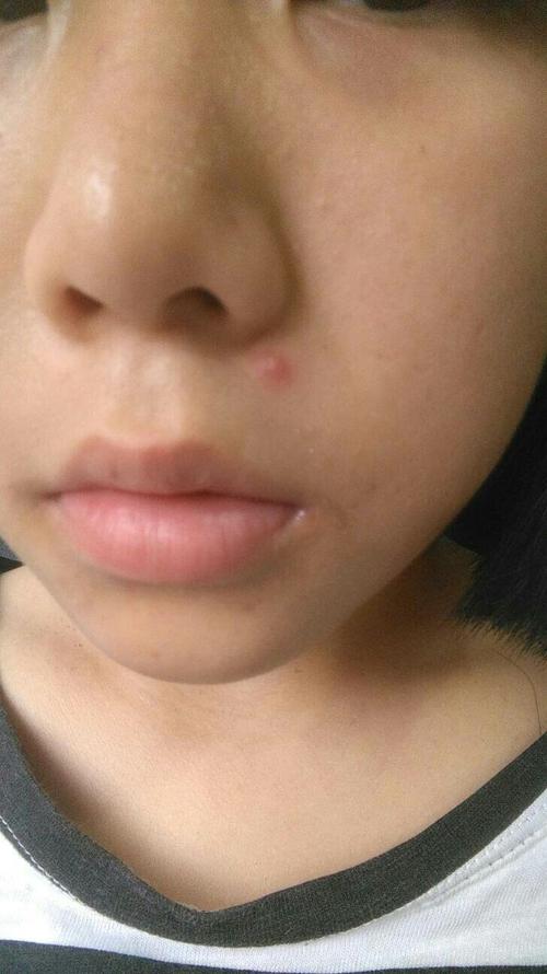 脸上的痘痘抠成了疤怎么最快痊愈(1)