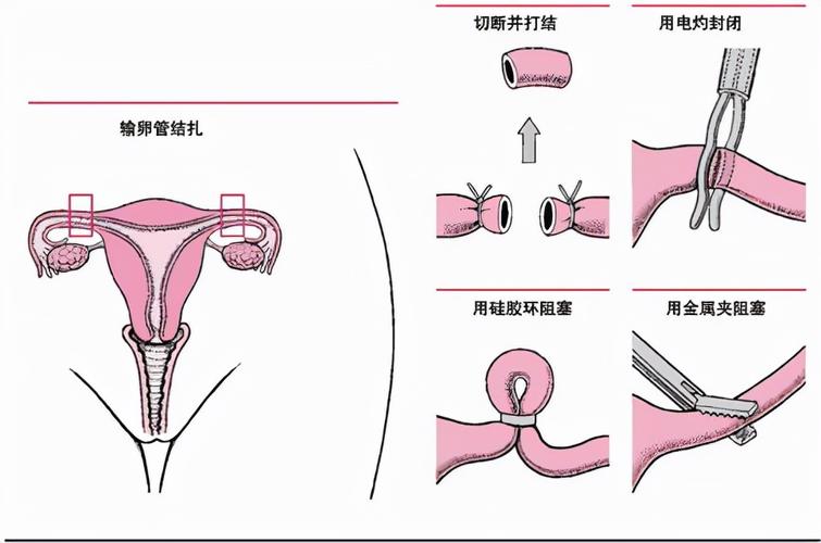 输卵管结扎术是怎么操作的呢(1)