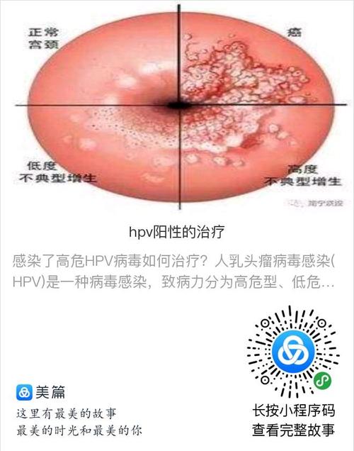 hpv病毒是性病吗(1)
