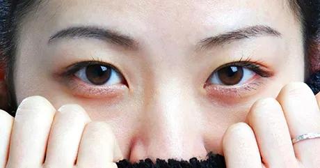 如何淡化黑眼圈有效方法（怎么快速消除黑眼圈最有效）(3)