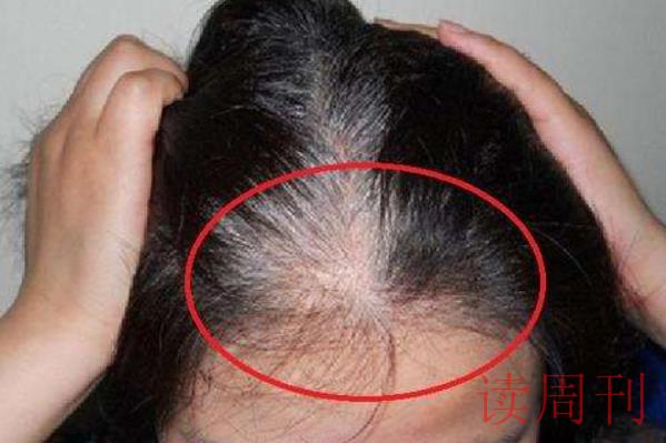 三个部位长白发最危险前额（后脑勺两侧长白发什么原因）