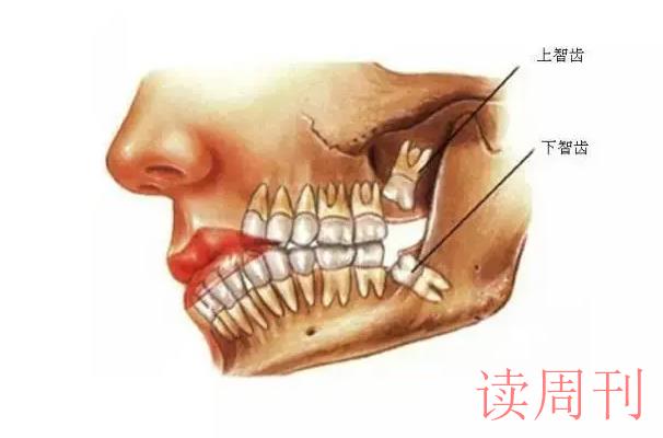 智齿一般是长在上颚还是下颚（下颌智齿比上颚智齿难拔）(1)