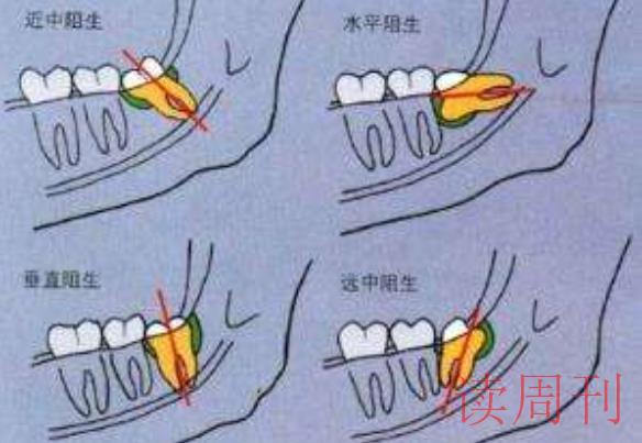 智齿一般是长在上颚还是下颚（下颌智齿比上颚智齿难拔）(2)