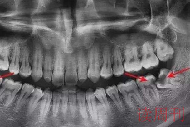 智齿一般是长在上颚还是下颚（下颌智齿比上颚智齿难拔）(3)