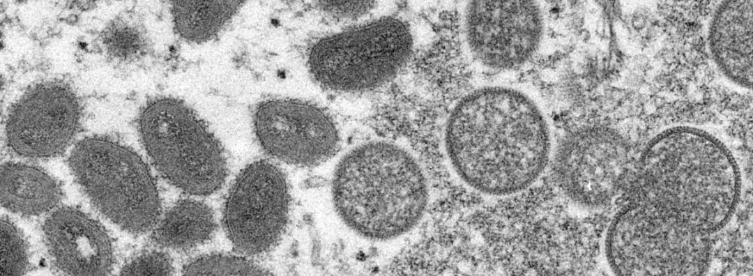 多国相继报告猴痘感染病例(1)