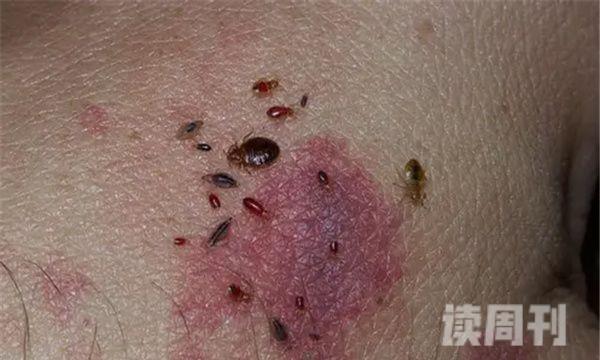 世界上最毒的十大虫子（蚊子遇到人群还会疯狂攻击）(3)