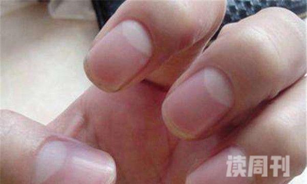 手指甲月牙越来越少（注意自己的饮食同时也应该注意休息）(4)