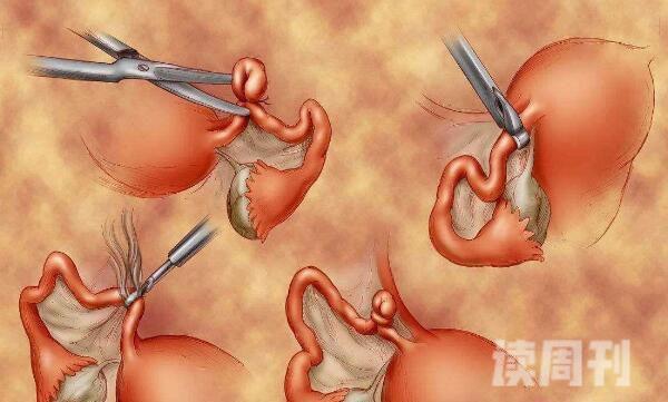 避孕的方式有哪些（美国将男性输卵管进行结扎）(1)