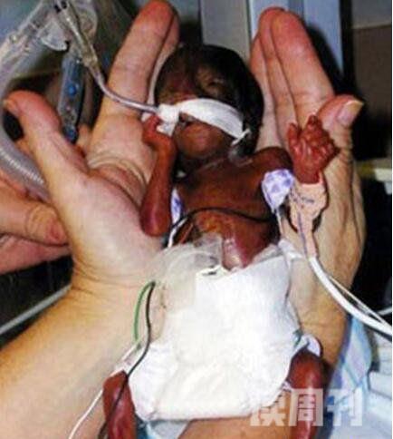 世界上最小的婴儿只有24cm长揭秘阿米利娅·泰勒现状怎样(3)
