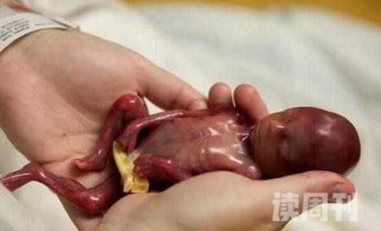 世界上最小的婴儿只有24cm长揭秘阿米利娅·泰勒现状怎样(4)