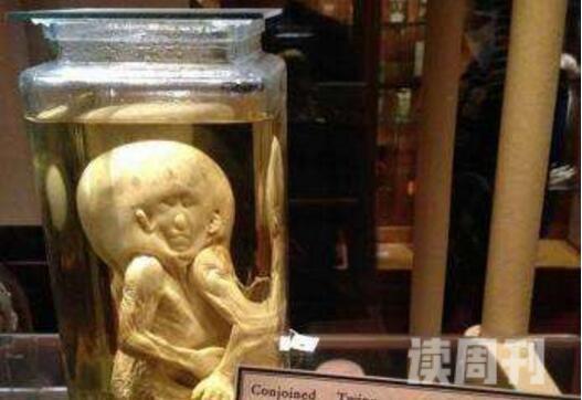 全球最恐怖博物馆美国费城马特博物馆(收藏2万具畸形尸体)(4)